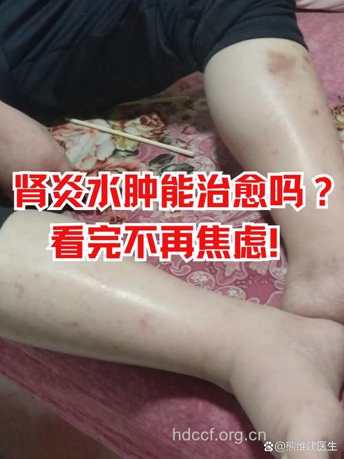 急性肾炎水肿治疗案例