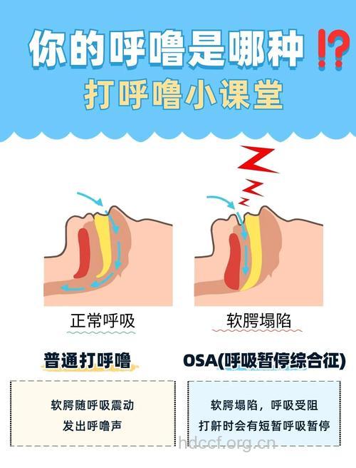 哪些方法可以缓解鼾症