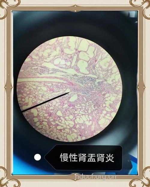 零距离接触慢性肾盂肾炎