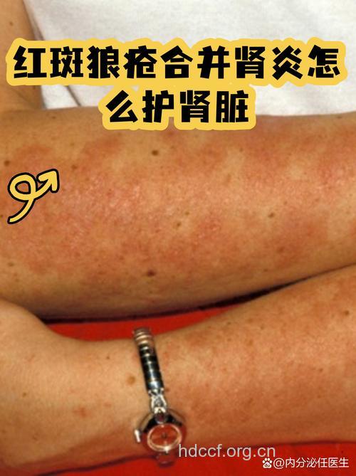 如何护理红斑狼疮伴肾损害