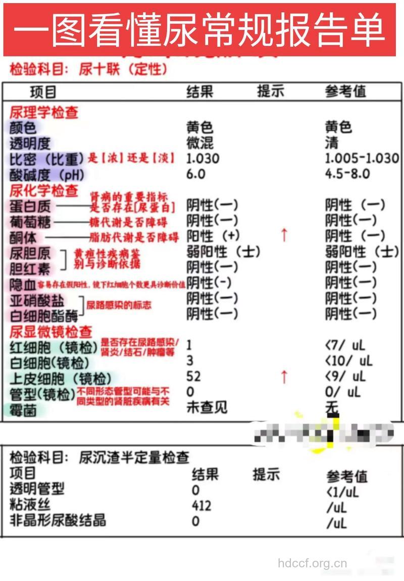 肾盂肾炎的尿常规你看懂了吗?