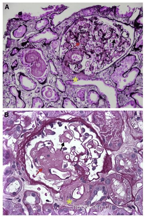 肾活检诊断肾淀粉样变性