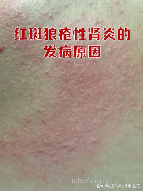 红斑狼疮患者易并发肾炎