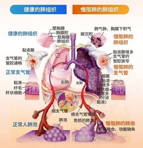 慢性阻塞性肺病是一种全身的疾病