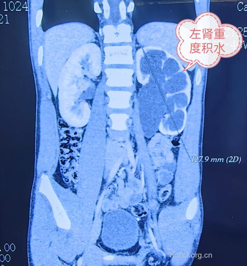小儿患肾积水的检查方法