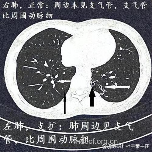 支气管扩张的症状