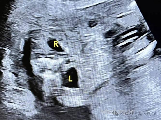 孕期胎儿肾积水不可轻易流产