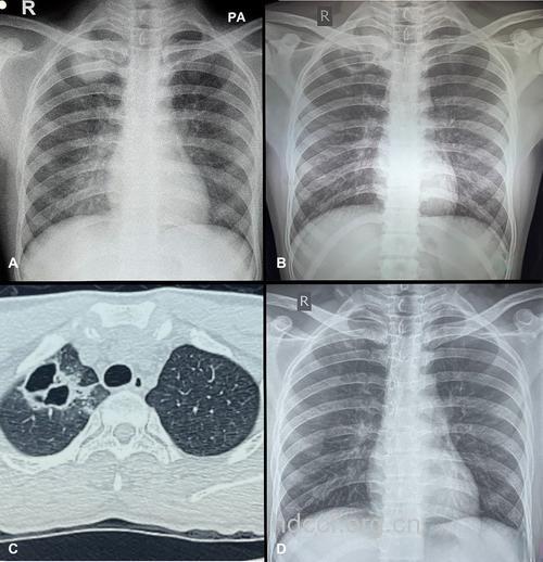 热带性肺嗜酸粒细胞浸润症