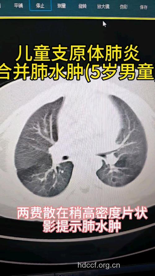 小儿肺脓肿有哪些症状