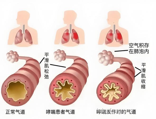 支气管哮喘有哪些变态反应