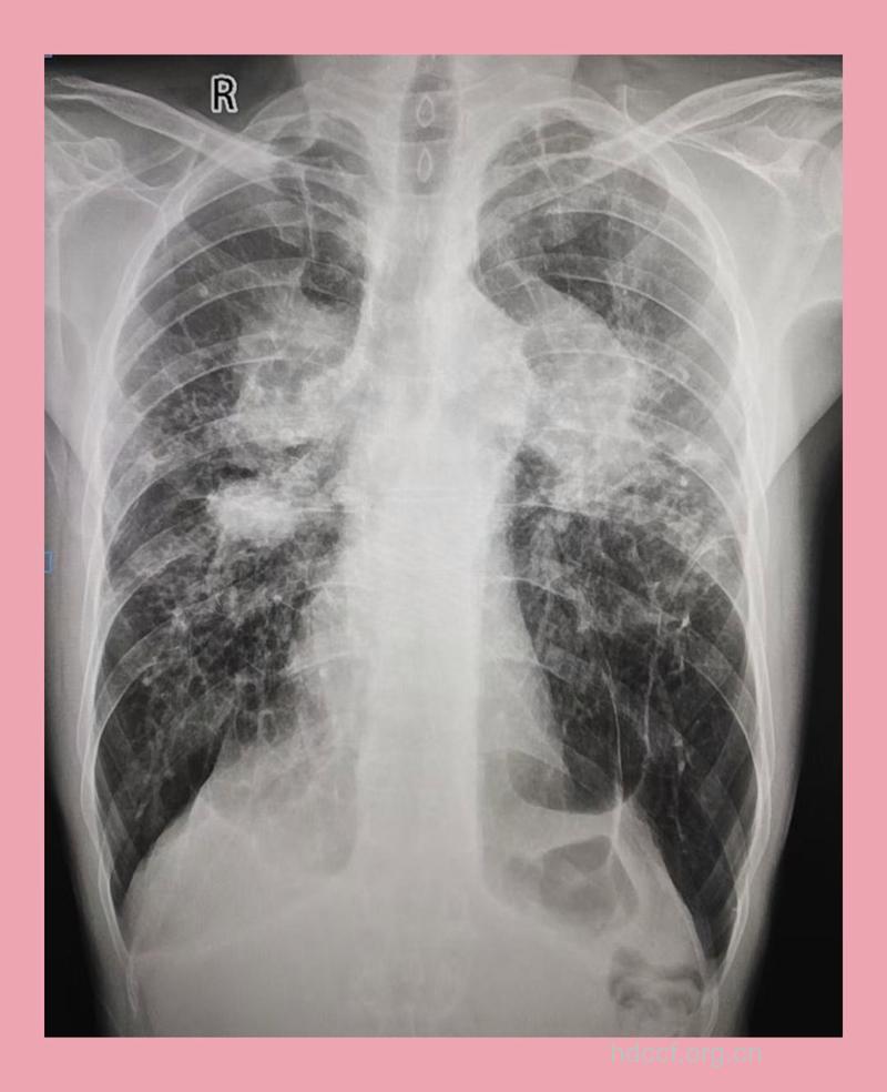 实验:矽肺的X线及CT的诊断分析