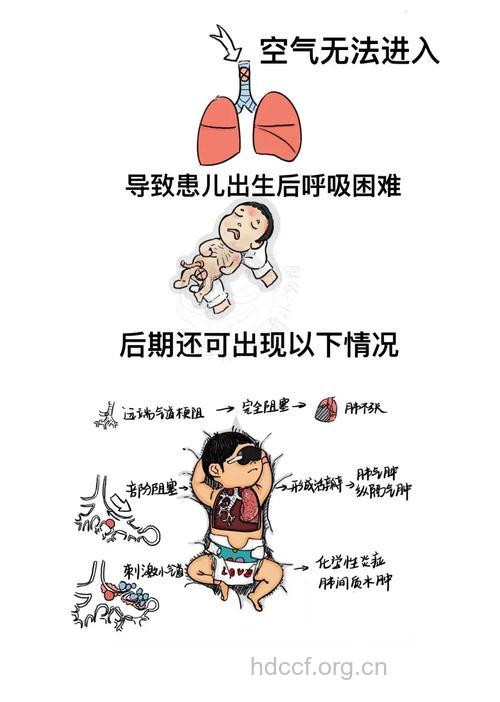 实验:新生儿胎粪吸入综合征例临床观察与分析