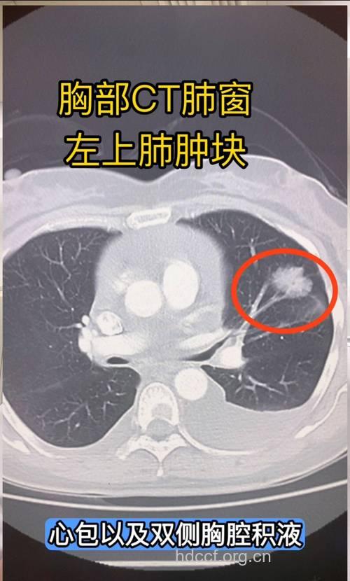 女性肺肿瘤症状有哪些