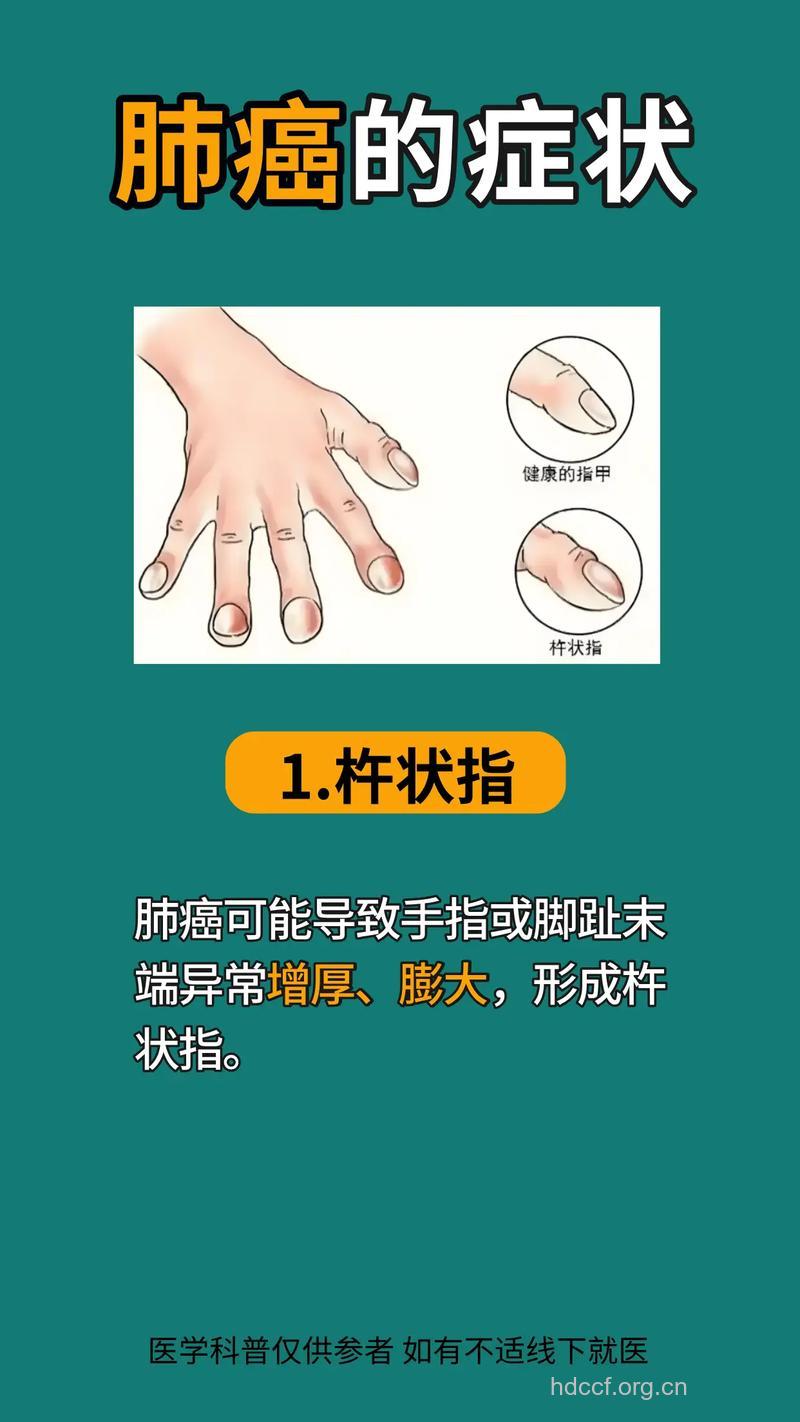 哪些症状能看出得了肺癌