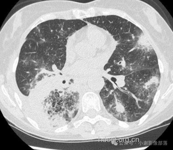 弥漫性肺癌的症状表现