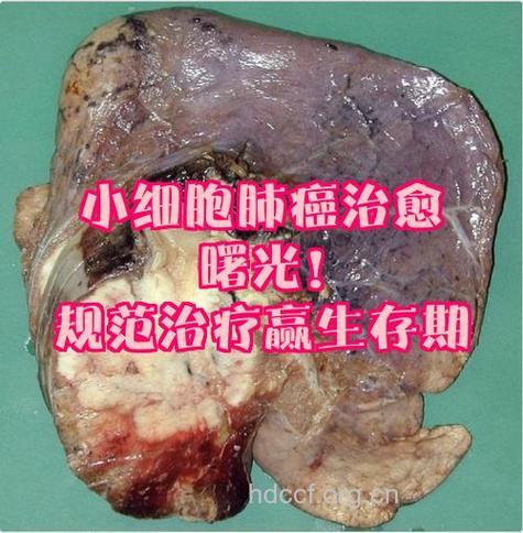 小细胞肺癌治愈几率有多大