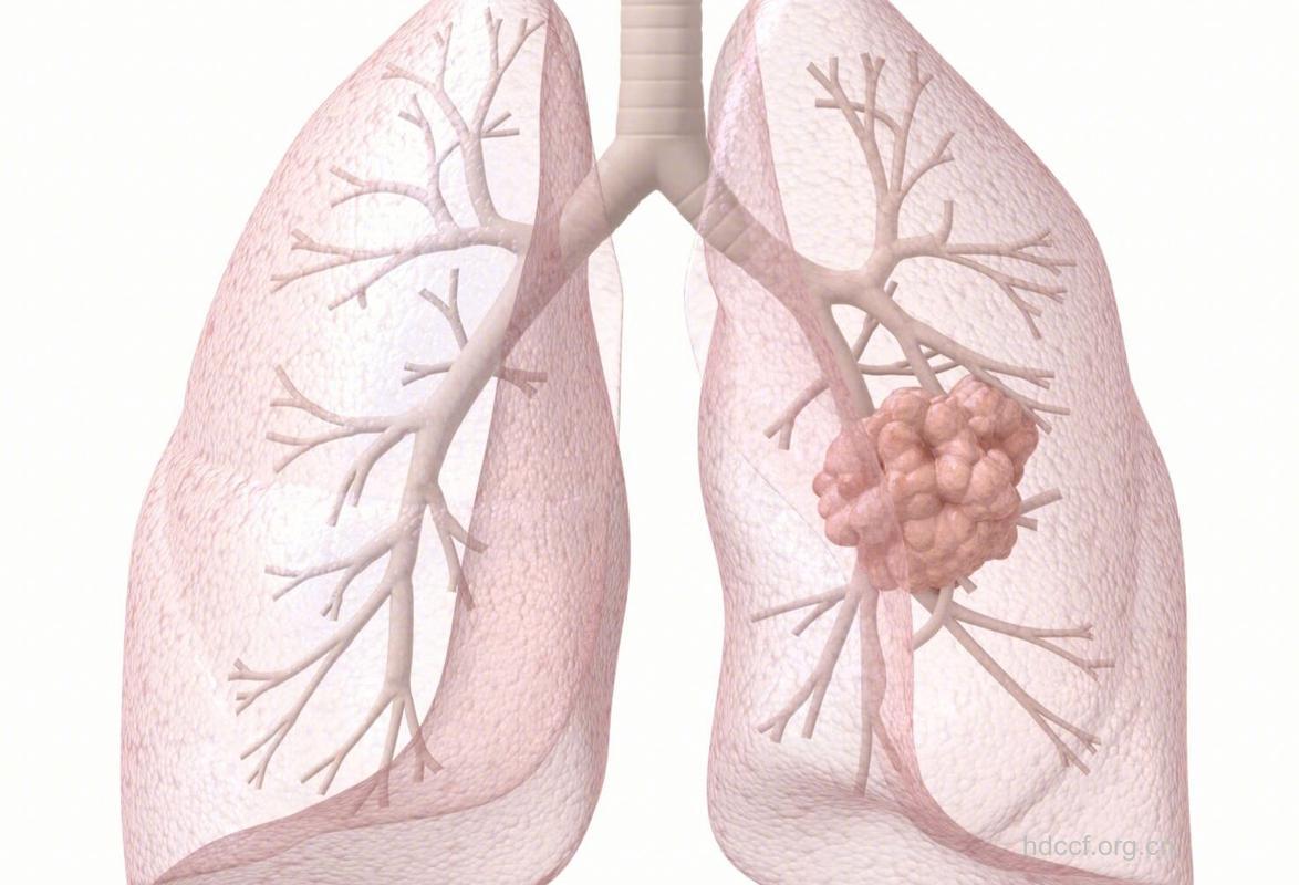 会诱发肺癌的气体有哪些