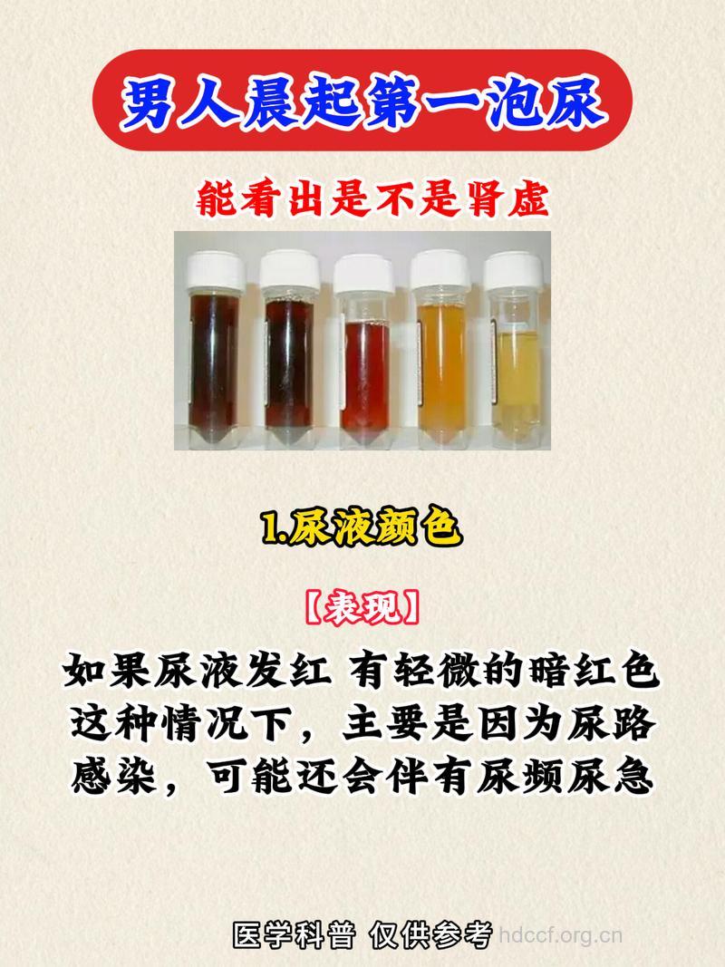 男人是否肾虚可以从尿液看出来