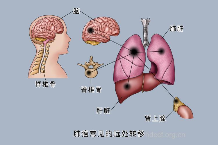 肺癌是怎么转移的呢