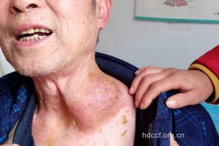 肺肿瘤晚期转移后有什么表现