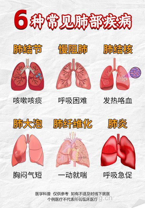 常见肺癌有哪些肺外症状呢