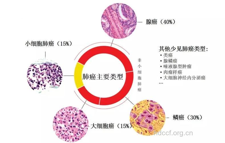 肺癌的病理特征是什么