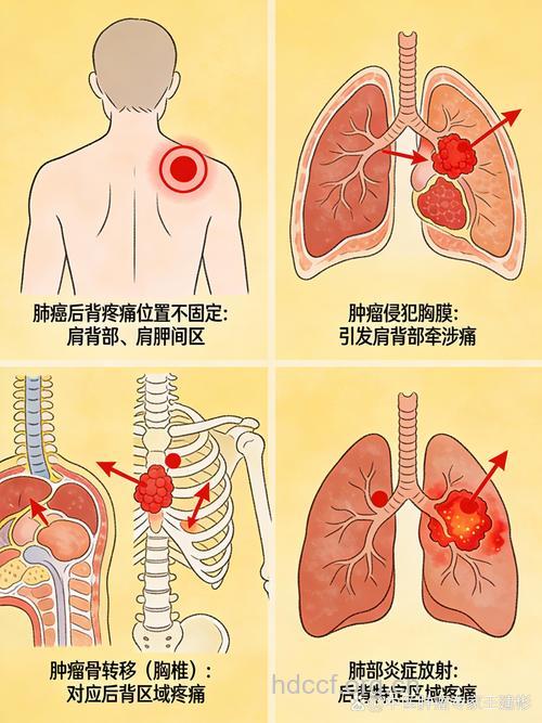 肺癌的中期症状发生在什么部位