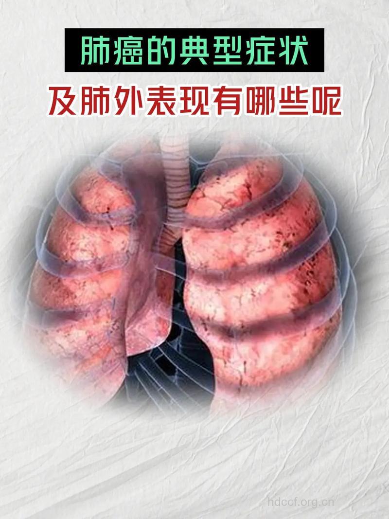 肺癌主要的肺外症状介绍