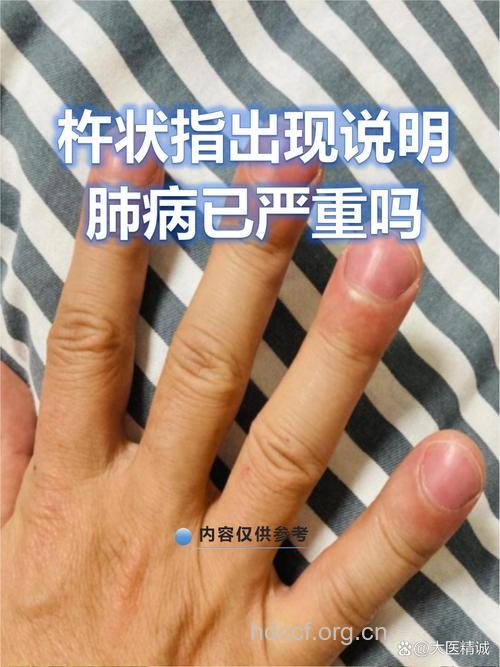 男性肺癌患者的症状有哪些