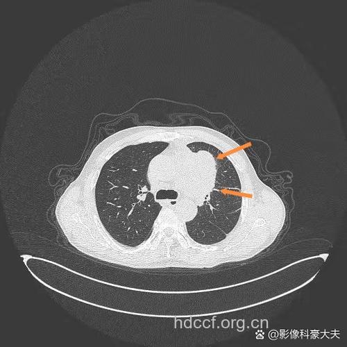 肺癌早期的肺外症状是什么