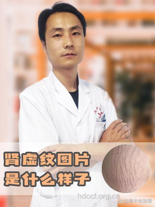 肾虚纹是啥提示肾虚?