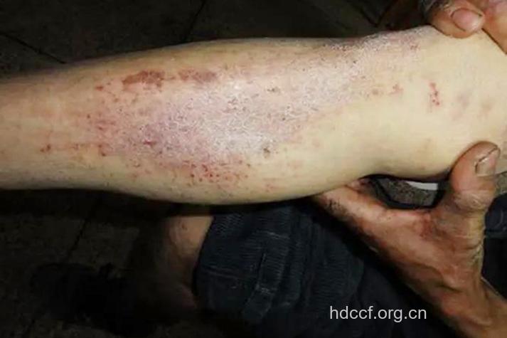 感染肺癌后症状有哪些