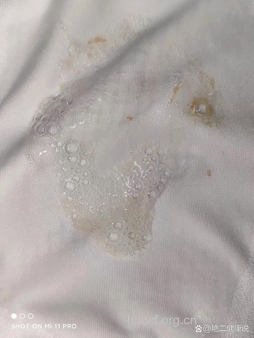 肺癌会出现泡沫痰症状吗