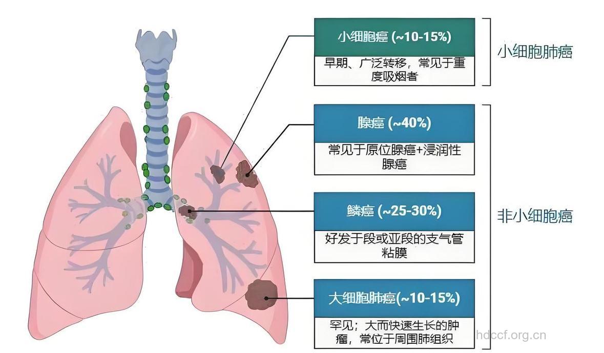 肺癌都有哪些具详细的分类