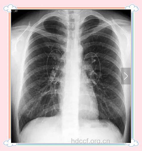 肺部有阴影就是肺癌？