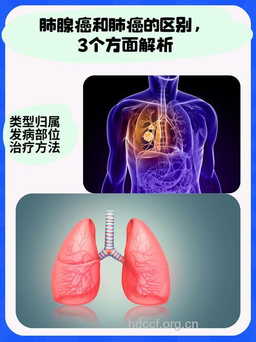 肺癌发病在男女之间有差异