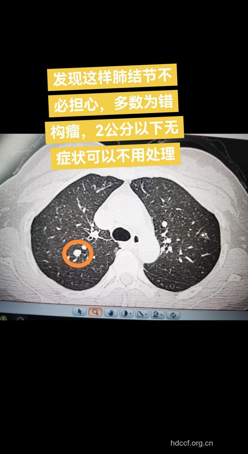 肺错构瘤分为哪几种?