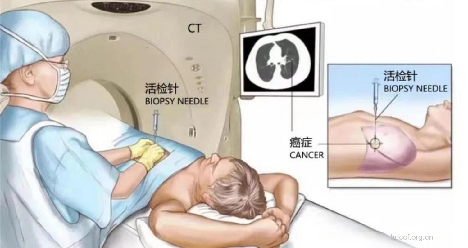 穿刺活检会促使肺癌转移吗？