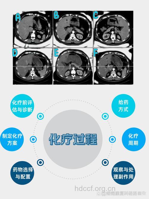 肺癌化疗后效果的决定因素