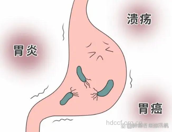 消化不良居然与肺癌沾亲带故