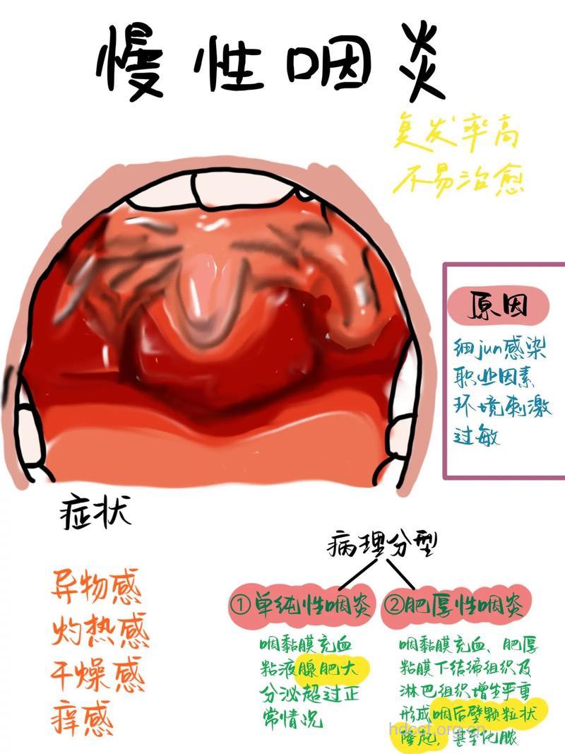 慢性鼻咽炎有哪些典型症状