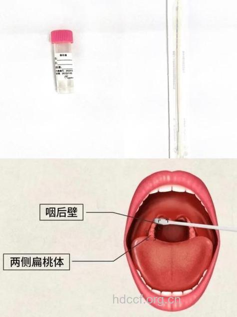 常见的咽炎的检查方式