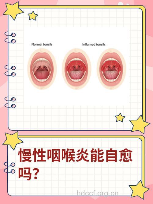 怎么正确认识慢性咽炎