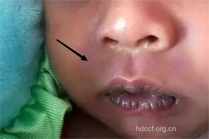 小儿先天性心脏病的早期症状