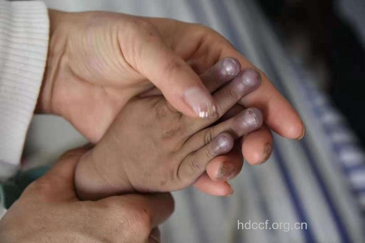 什么是青紫型先天性心脏病