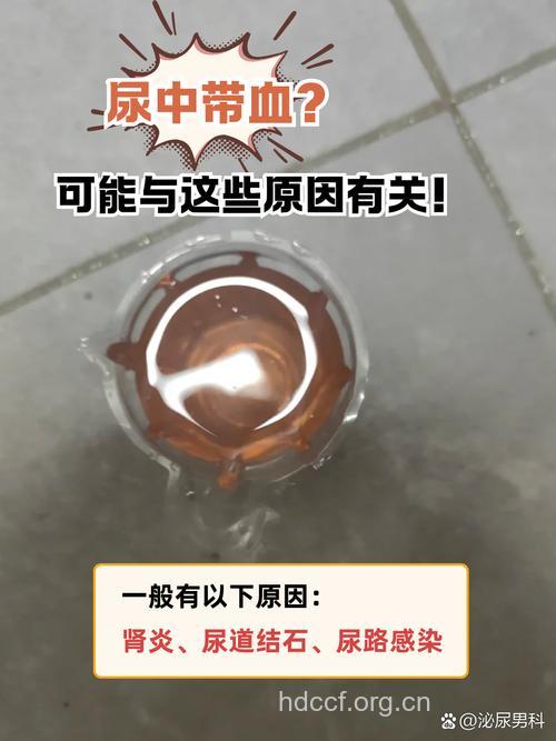 儿童小便出血 可能是肾脏出了问题