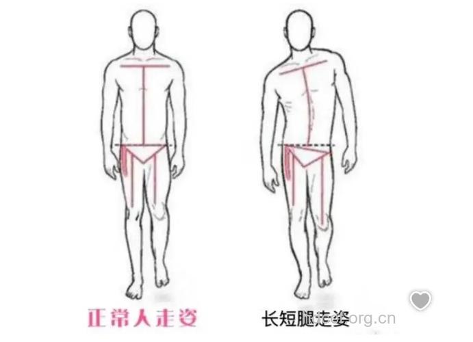 心脏病与糖尿病的信号--男性下肢长短
