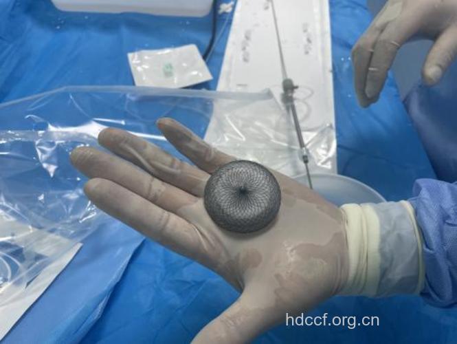 带孔封堵器治疗房缺好