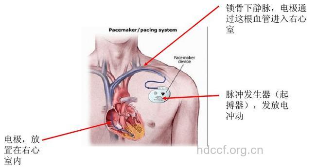 心律失常患者怎么安装起搏器