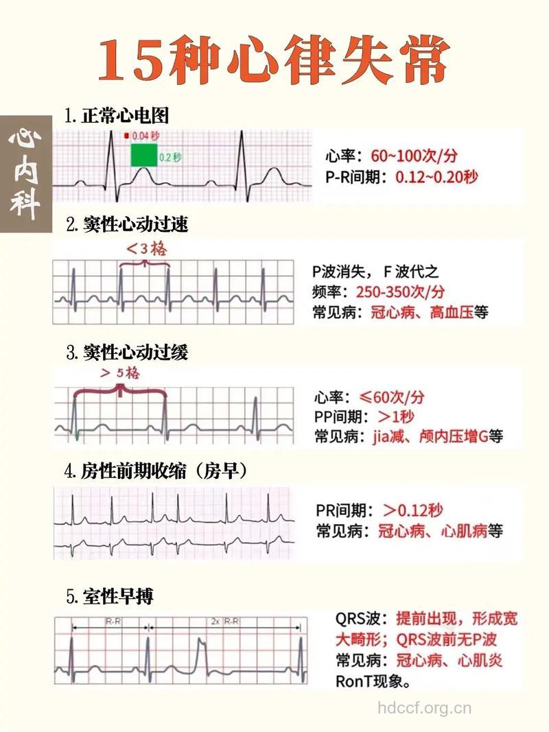 心律失常的三种表现形式